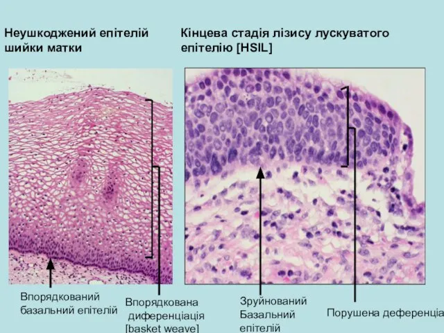Неушкоджений епітелій шийки матки Кінцева стадія лізису лускуватого епітелію [HSIL] Впорядкована диференціація
