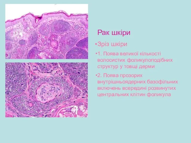 Рак шкіри Зріз шкіри 1. Поява великої кількості волосистих фоликулоподібних структур у