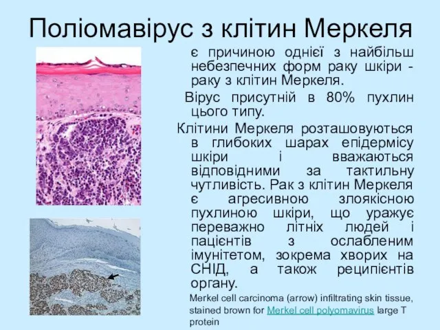 Поліомавірус з клітин Меркеля є причиною однієї з найбільш небезпечних форм раку