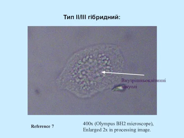 Тип II/III гібридний: 400x (Olympus BH2 microscope), Enlarged 2x in processing image. Внутрішньоклітинні вакуолі Reference 7