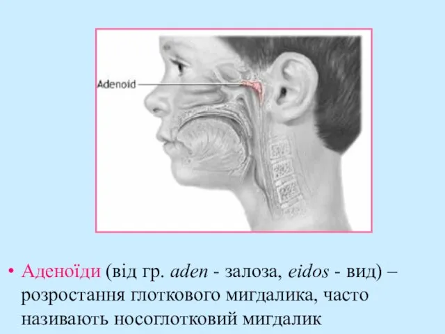 Аденоїди (від гр. аden - залоза, eidos - вид) – розростання глоткового