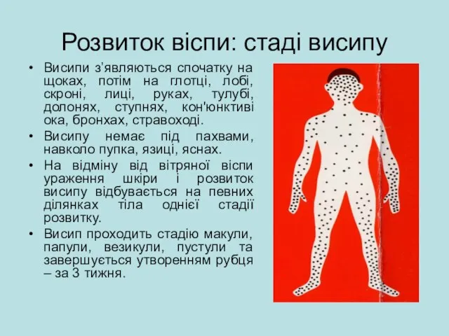 Розвиток віспи: стаді висипу Висипи з’являються спочатку на щоках, потім на глотці,