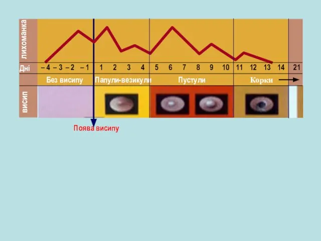 лихоманка висип Без висипу Папули-везикули Пустули Корки Поява висипу Дні – 4