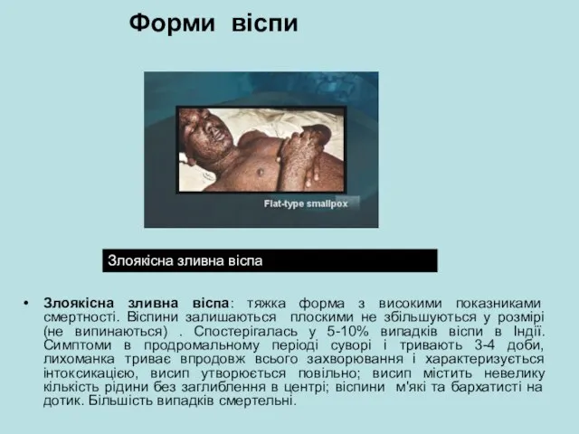 Форми віспи Злоякісна зливна віспа: тяжка форма з високими показниками смертності. Віспини