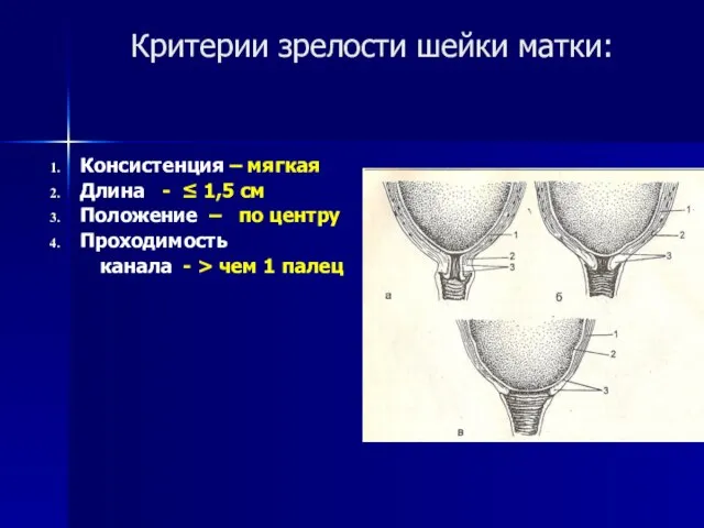 Критерии зрелости шейки матки: Консистенция – мягкая Длина - ≤ 1,5 см