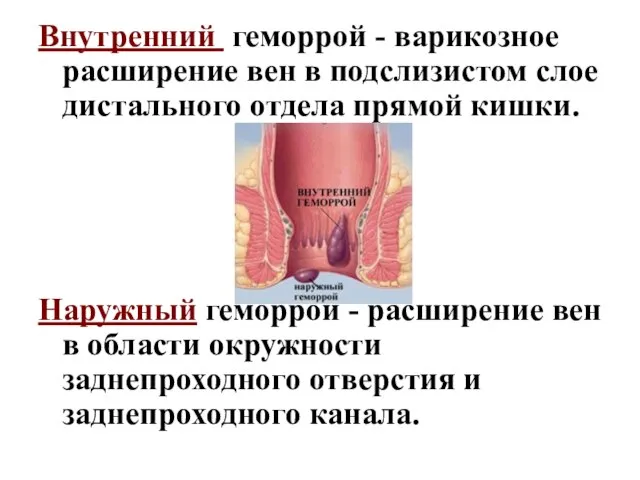 Внутренний геморрой - варикозное расширение вен в подслизистом слое дистального отдела прямой