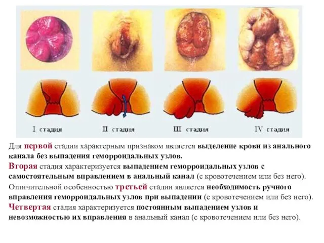 Для первой стадии характерным признаком является выделение крови из анального канала без