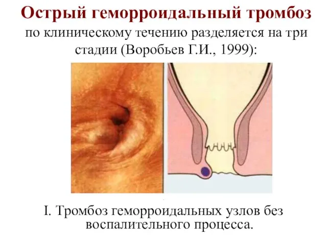 Острый геморроидальный тромбоз по клиническому течению разделяется на три стадии (Воробьев Г.И.,