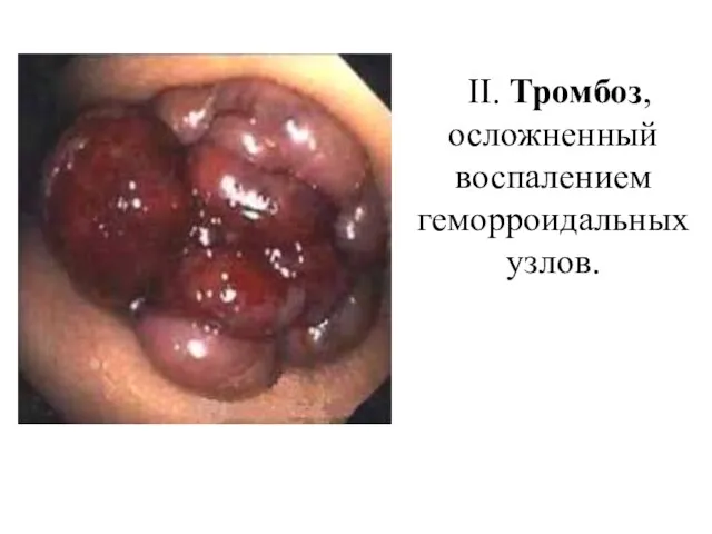 II. Тромбоз, осложненный воспалением геморроидальных узлов.