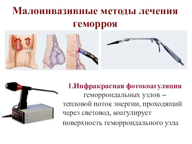 Малоинвазивные методы лечения геморроя 1.Инфракрасная фотокоагуляция геморроидальных узлов – тепловой поток энергии,