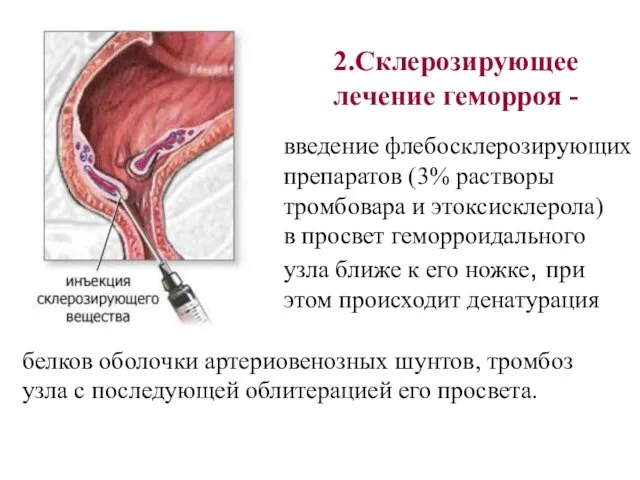 2.Склерозирующее лечение геморроя - введение флебосклерозирующих препаратов (3% растворы тромбовара и этоксисклерола)