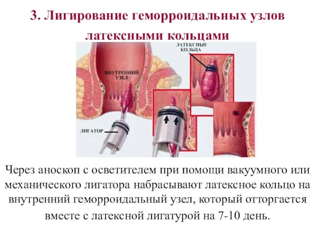 3. Лигирование геморроидальных узлов латексными кольцами Через аноскоп с осветителем при помощи