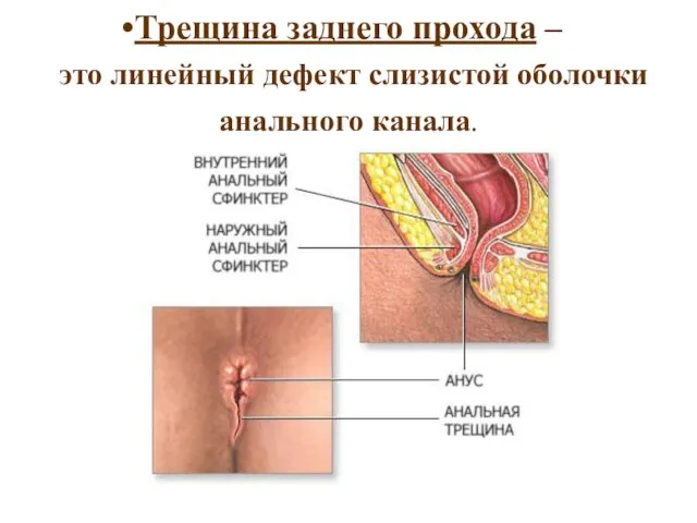 Трещина заднего прохода – это линейный дефект слизистой оболочки анального канала.