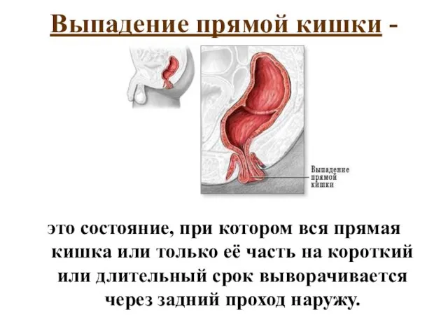 Выпадение прямой кишки - это состояние, при котором вся прямая кишка или