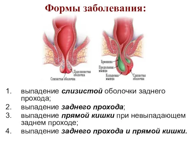 Формы заболевания: выпадение слизистой оболочки заднего прохода; выпадение заднего прохода; выпадение прямой