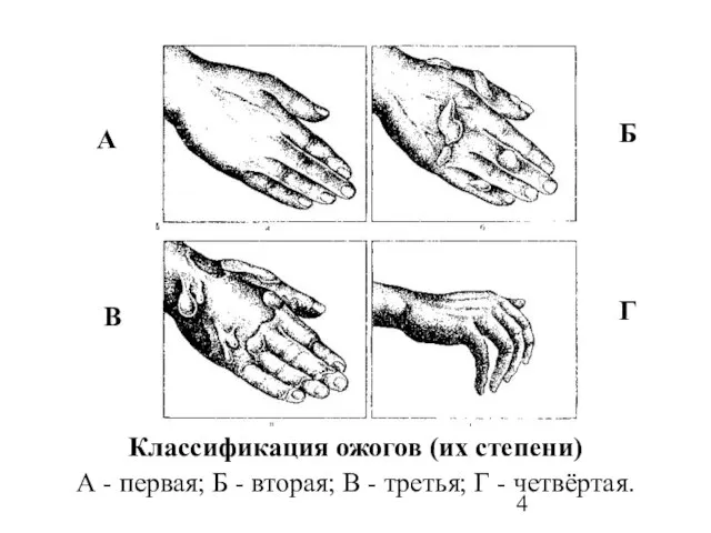 А Б В Г Классификация ожогов (их степени) А - первая; Б