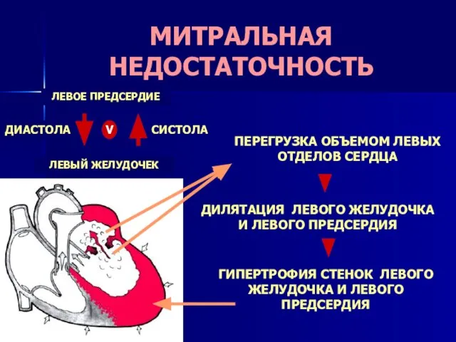 МИТРАЛЬНАЯ НЕДОСТАТОЧНОСТЬ ПЕРЕГРУЗКА ОБЪЕМОМ ЛЕВЫХ ОТДЕЛОВ СЕРДЦА ГИПЕРТРОФИЯ СТЕНОК ЛЕВОГО ЖЕЛУДОЧКА И