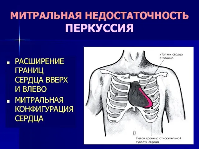 МИТРАЛЬНАЯ НЕДОСТАТОЧНОСТЬ ПЕРКУССИЯ РАСШИРЕНИЕ ГРАНИЦ СЕРДЦА ВВЕРХ И ВЛЕВО МИТРАЛЬНАЯ КОНФИГУРАЦИЯ СЕРДЦА