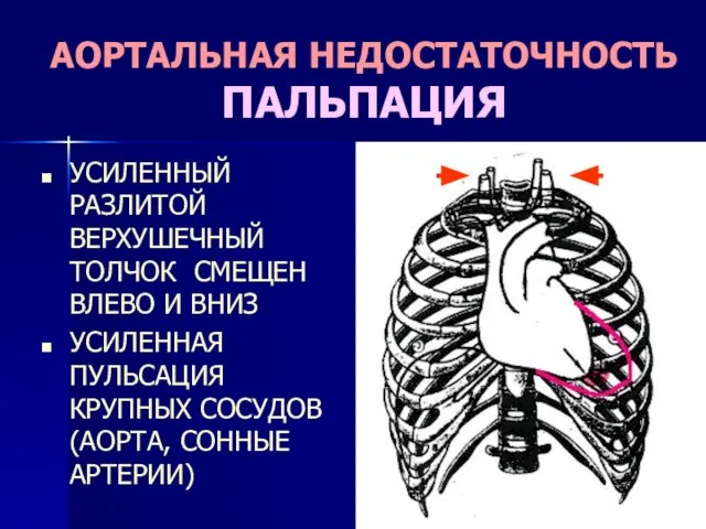 АОРТАЛЬНАЯ НЕДОСТАТОЧНОСТЬ ПАЛЬПАЦИЯ УСИЛЕННЫЙ РАЗЛИТОЙ ВЕРХУШЕЧНЫЙ ТОЛЧОК СМЕЩЕН ВЛЕВО И ВНИЗ УСИЛЕННАЯ