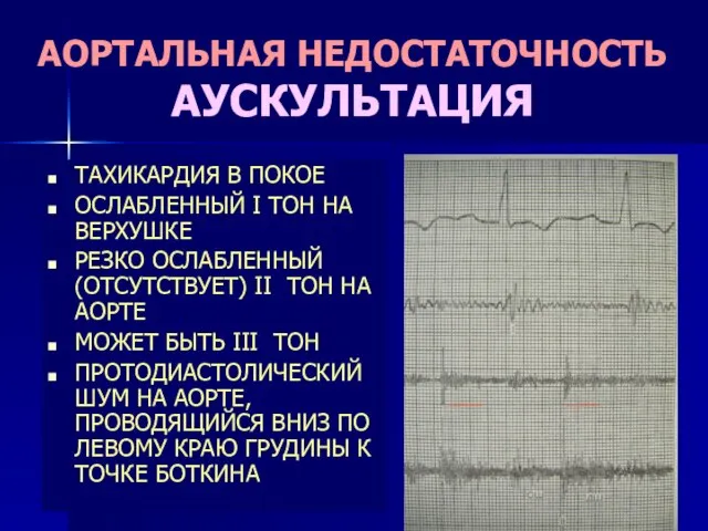 АОРТАЛЬНАЯ НЕДОСТАТОЧНОСТЬ АУСКУЛЬТАЦИЯ ТАХИКАРДИЯ В ПОКОЕ ОСЛАБЛЕННЫЙ I ТОН НА ВЕРХУШКЕ РЕЗКО