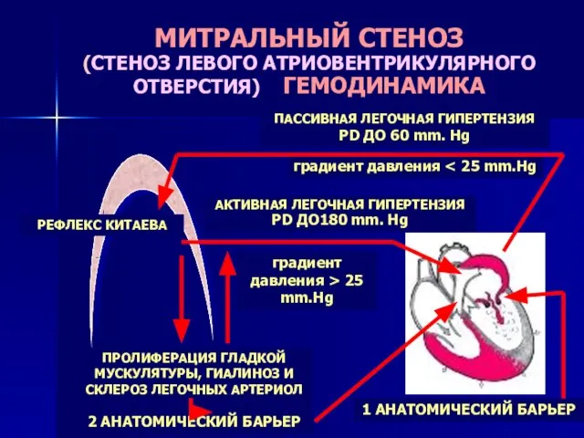 МИТРАЛЬНЫЙ СТЕНОЗ (СТЕНОЗ ЛЕВОГО АТРИОВЕНТРИКУЛЯРНОГО ОТВЕРСТИЯ) ГЕМОДИНАМИКА ПАССИВНАЯ ЛЕГОЧНАЯ ГИПЕРТЕНЗИЯ РD ДО