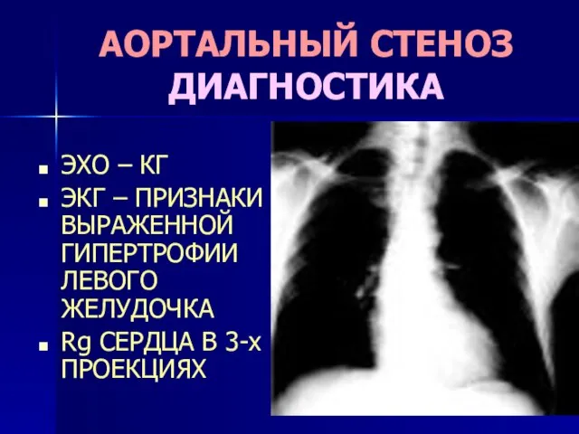 АОРТАЛЬНЫЙ СТЕНОЗ ДИАГНОСТИКА ЭХО – КГ ЭКГ – ПРИЗНАКИ ВЫРАЖЕННОЙ ГИПЕРТРОФИИ ЛЕВОГО