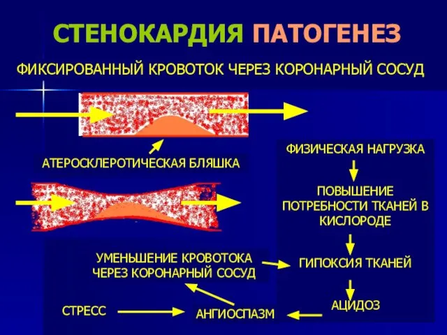 СТЕНОКАРДИЯ ПАТОГЕНЕЗ ФИКСИРОВАННЫЙ КРОВОТОК ЧЕРЕЗ КОРОНАРНЫЙ СОСУД ФИЗИЧЕСКАЯ НАГРУЗКА ПОВЫШЕНИЕ ПОТРЕБНОСТИ ТКАНЕЙ