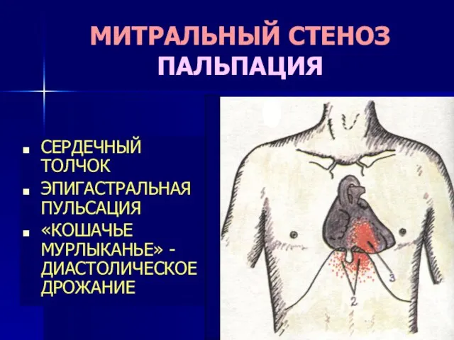 МИТРАЛЬНЫЙ СТЕНОЗ ПАЛЬПАЦИЯ СЕРДЕЧНЫЙ ТОЛЧОК ЭПИГАСТРАЛЬНАЯ ПУЛЬСАЦИЯ «КОШАЧЬЕ МУРЛЫКАНЬЕ» - ДИАСТОЛИЧЕСКОЕ ДРОЖАНИЕ