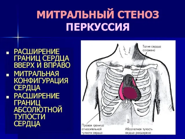 МИТРАЛЬНЫЙ СТЕНОЗ ПЕРКУССИЯ РАСШИРЕНИЕ ГРАНИЦ СЕРДЦА ВВЕРХ И ВПРАВО МИТРАЛЬНАЯ КОНФИГУРАЦИЯ СЕРДЦА