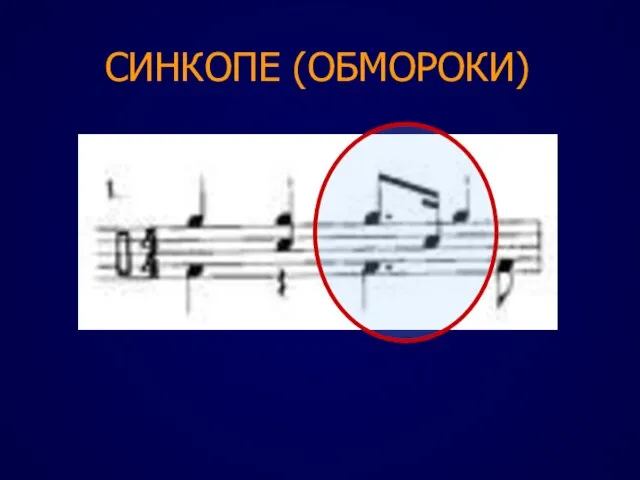 СИНКОПЕ (ОБМОРОКИ)