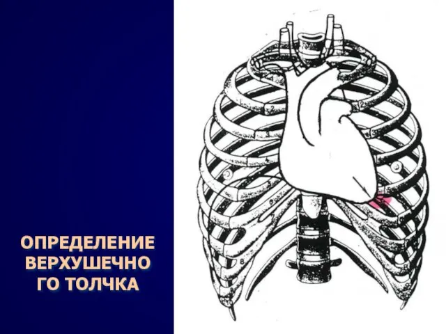 ОПРЕДЕЛЕНИЕ ВЕРХУШЕЧНОГО ТОЛЧКА