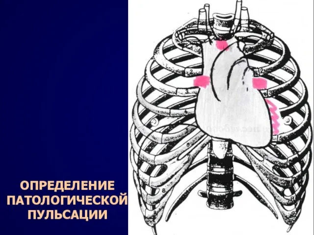 ОПРЕДЕЛЕНИЕ ПАТОЛОГИЧЕСКОЙ ПУЛЬСАЦИИ