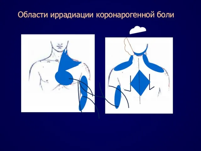 Области иррадиации коронарогенной боли