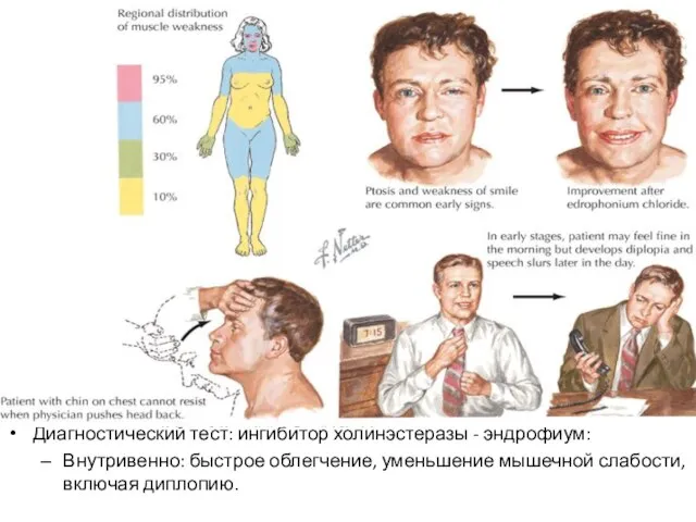 Диагностический тест: ингибитор холинэстеразы - эндрофиум: Внутривенно: быстрое облегчение, уменьшение мышечной слабости, включая диплопию.