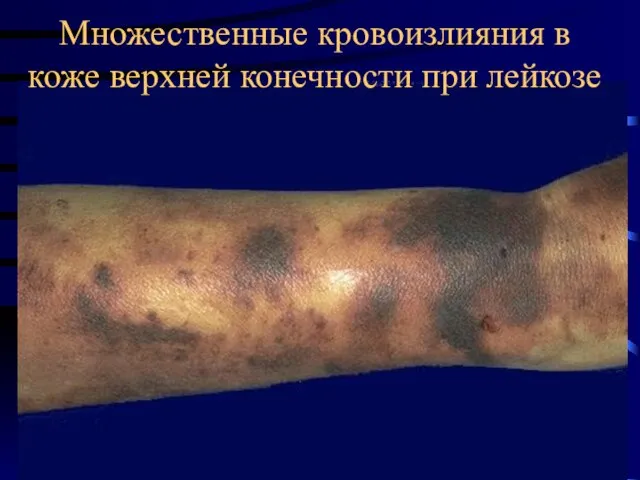 Множественные кровоизлияния в коже верхней конечности при лейкозе