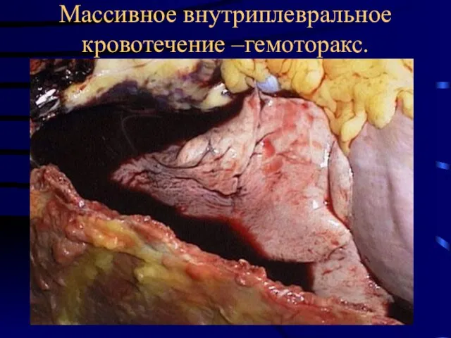 Массивное внутриплевральное кровотечение –гемоторакс.