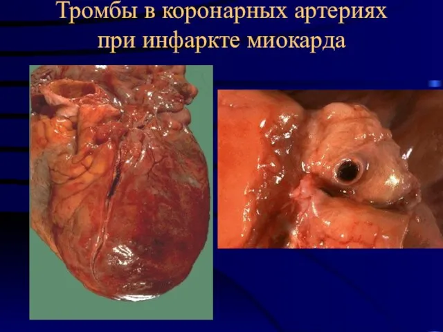 Тромбы в коронарных артериях при инфаркте миокарда