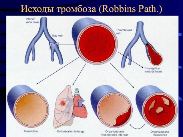 Исходы тромбоза (Robbins Path.)