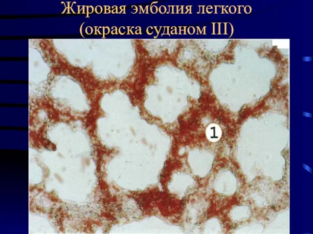 Жировая эмболия легкого (окраска суданом III)