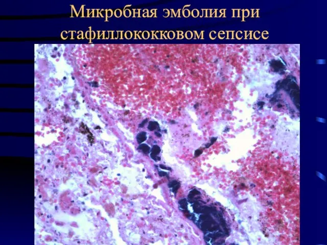Микробная эмболия при стафиллококковом сепсисе