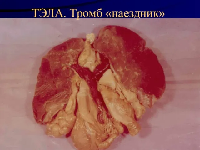 ТЭЛА. Тромб «наездник»