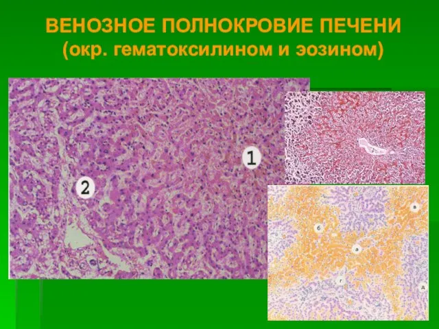 ВЕНОЗНОЕ ПОЛНОКРОВИЕ ПЕЧЕНИ (окр. гематоксилином и эозином)