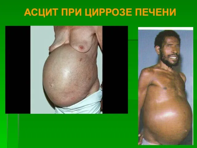 АСЦИТ ПРИ ЦИРРОЗЕ ПЕЧЕНИ