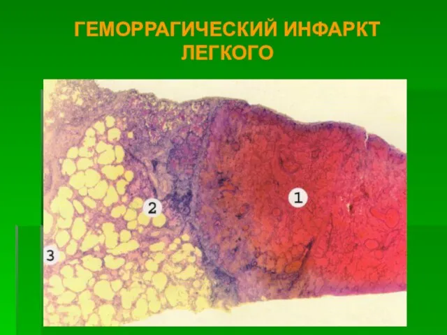 ГЕМОРРАГИЧЕСКИЙ ИНФАРКТ ЛЕГКОГО