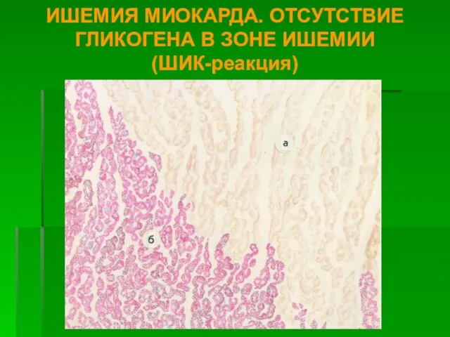 ИШЕМИЯ МИОКАРДА. ОТСУТСТВИЕ ГЛИКОГЕНА В ЗОНЕ ИШЕМИИ (ШИК-реакция)