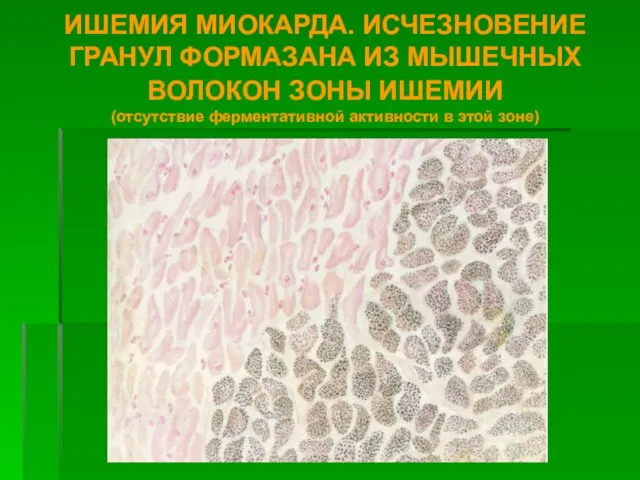 ИШЕМИЯ МИОКАРДА. ИСЧЕЗНОВЕНИЕ ГРАНУЛ ФОРМАЗАНА ИЗ МЫШЕЧНЫХ ВОЛОКОН ЗОНЫ ИШЕМИИ (отсутствие ферментативной активности в этой зоне)