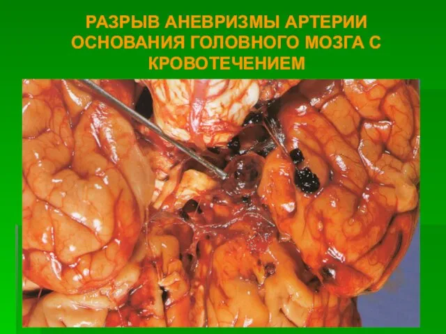 РАЗРЫВ АНЕВРИЗМЫ АРТЕРИИ ОСНОВАНИЯ ГОЛОВНОГО МОЗГА С КРОВОТЕЧЕНИЕМ