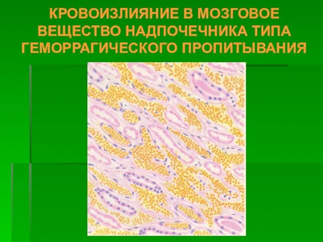 КРОВОИЗЛИЯНИЕ В МОЗГОВОЕ ВЕЩЕСТВО НАДПОЧЕЧНИКА ТИПА ГЕМОРРАГИЧЕСКОГО ПРОПИТЫВАНИЯ