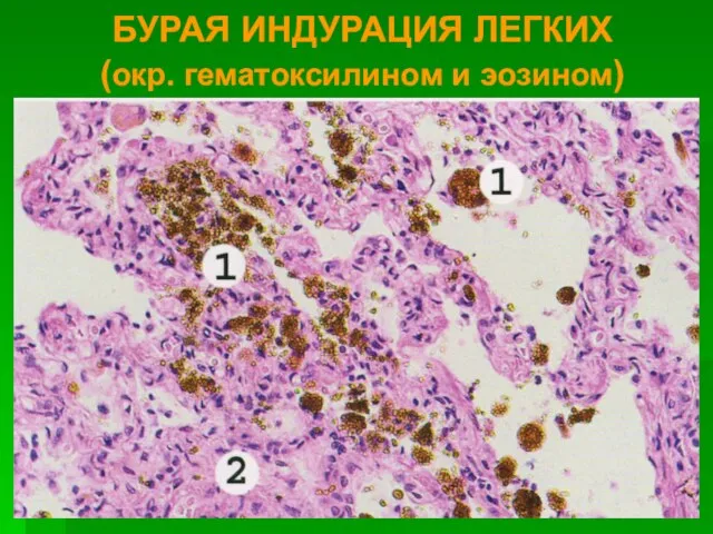 БУРАЯ ИНДУРАЦИЯ ЛЕГКИХ (окр. гематоксилином и эозином)