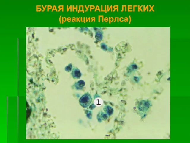 БУРАЯ ИНДУРАЦИЯ ЛЕГКИХ (реакция Перлса)